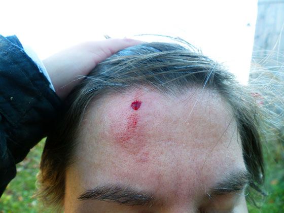 Head wound